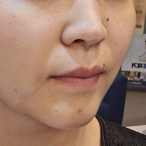 수술전