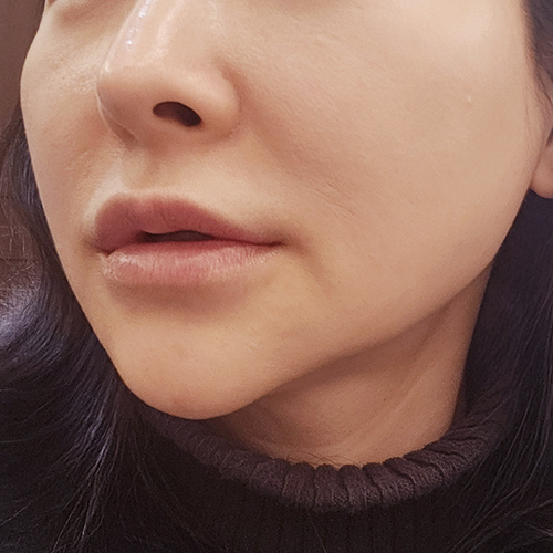 수술전