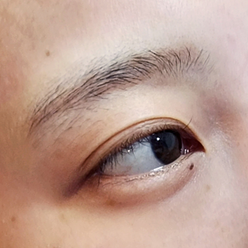 수술전