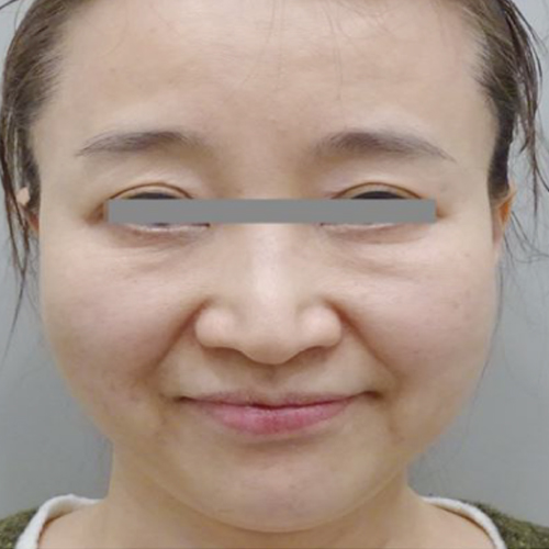 수술전