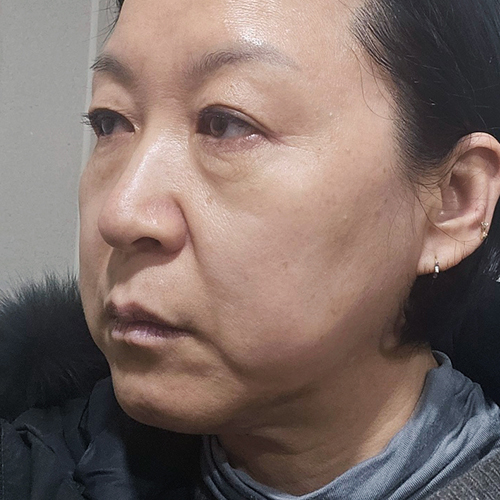 수술전
