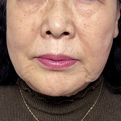 수술전