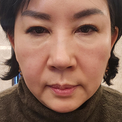 수술전